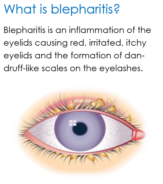 Blepharitis and Styes Mid Atlantic Cornea Consultants